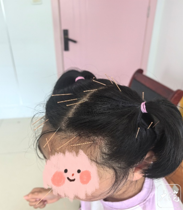 炒股配资之家 小叶医探|用“针尖”点亮“星光” 帮助“星星的孩子”走出孤独